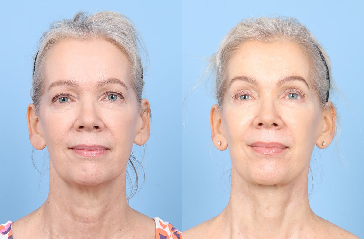 Facelift Before & After Gallery - Patient 617214 - Image 1
