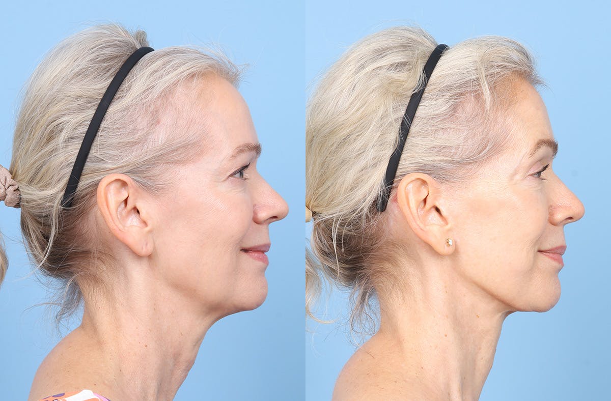 Facelift Before & After Gallery - Patient 617214 - Image 3