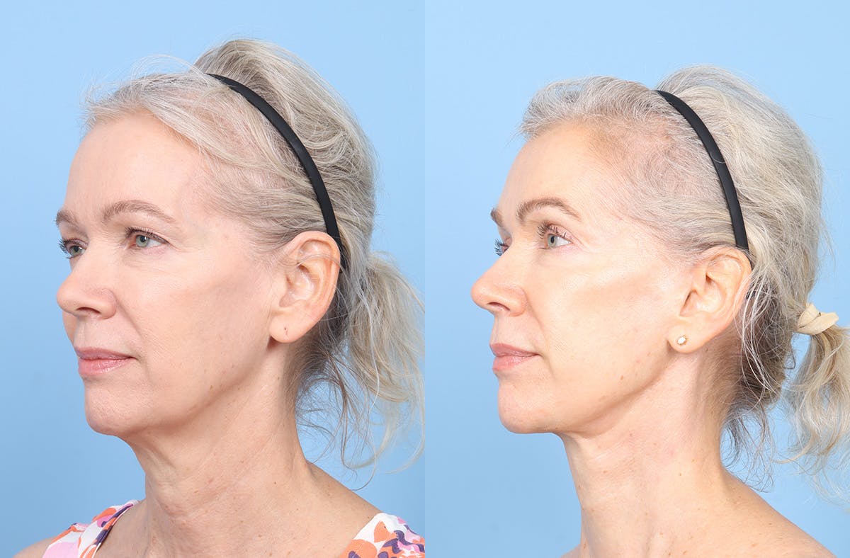 Facelift Before & After Gallery - Patient 617214 - Image 4