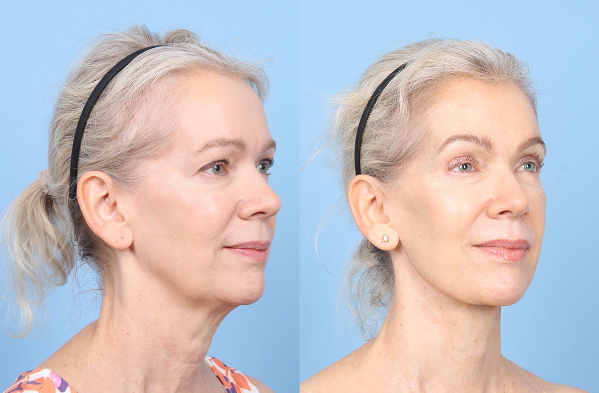 Facelift Before & After Gallery - Patient 617214 - Image 2