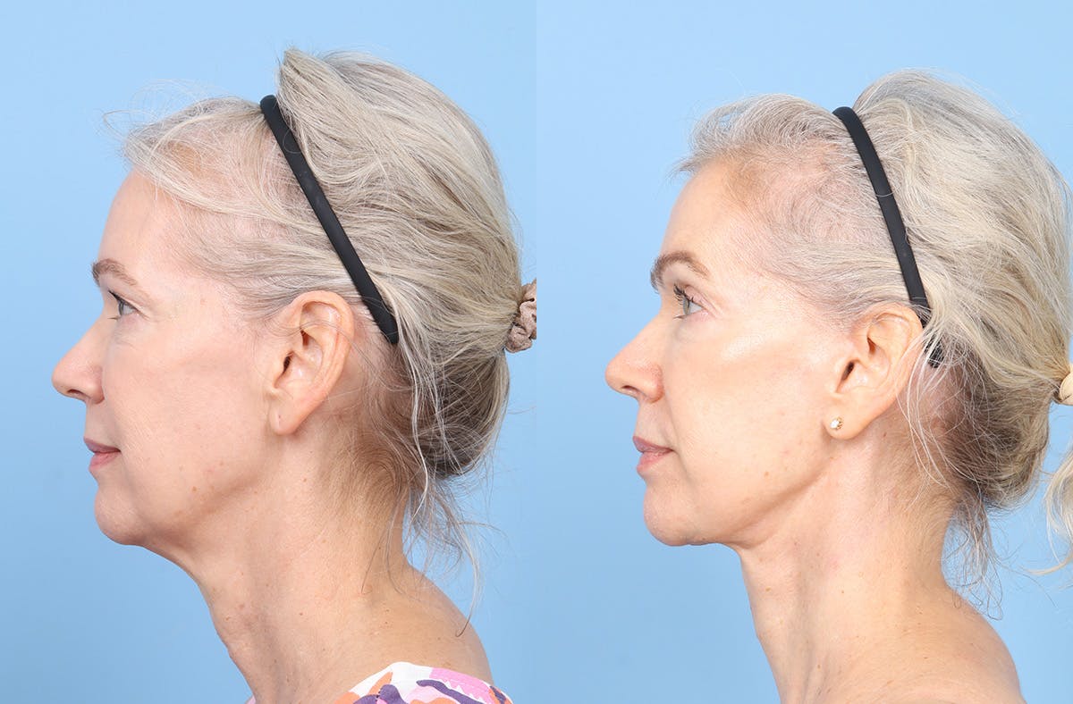 Facelift Before & After Gallery - Patient 617214 - Image 5