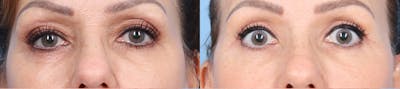 Eyelid Surgery Before & After Gallery - Patient 145850 - Image 1