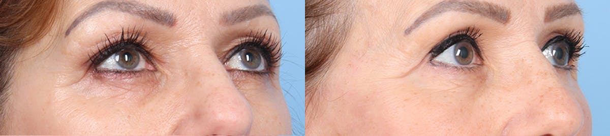 Eyelid Surgery Before & After Gallery - Patient 145850 - Image 2