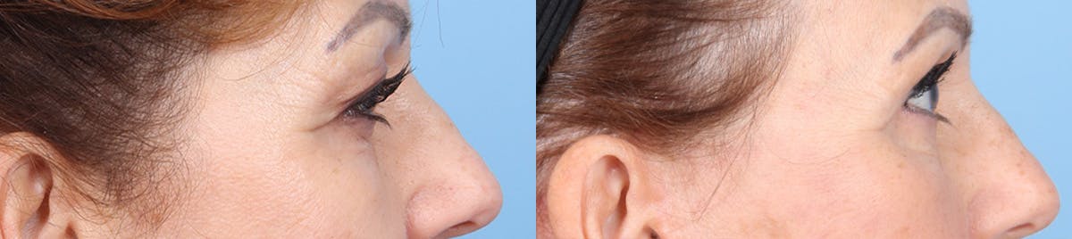 Eyelid Surgery Before & After Gallery - Patient 145850 - Image 3