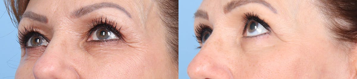 Eyelid Surgery Before & After Gallery - Patient 145850 - Image 4