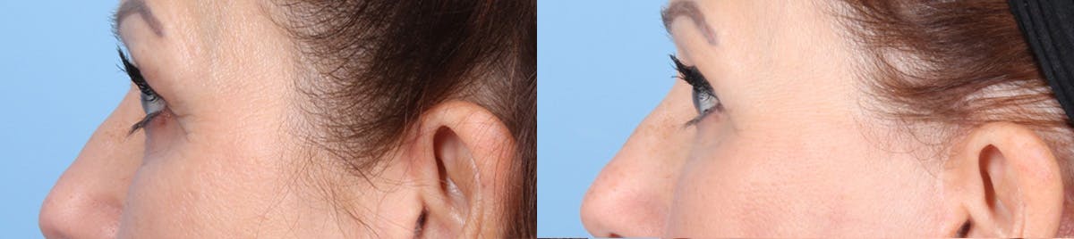 Eyelid Surgery Before & After Gallery - Patient 145850 - Image 5