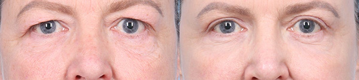 Eyelid Surgery Before & After Gallery - Patient 340727 - Image 1