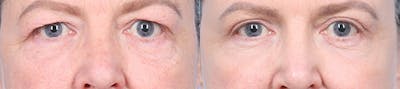 Eyelid Surgery Before & After Gallery - Patient 340727 - Image 1