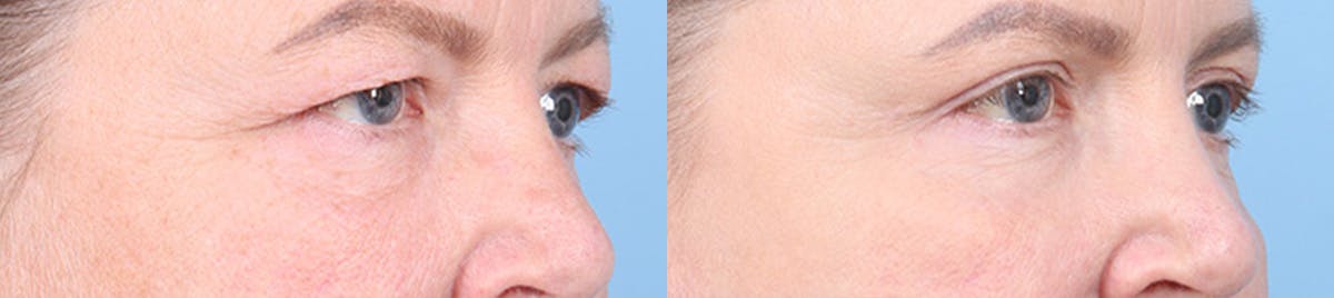 Eyelid Surgery Before & After Gallery - Patient 340727 - Image 2