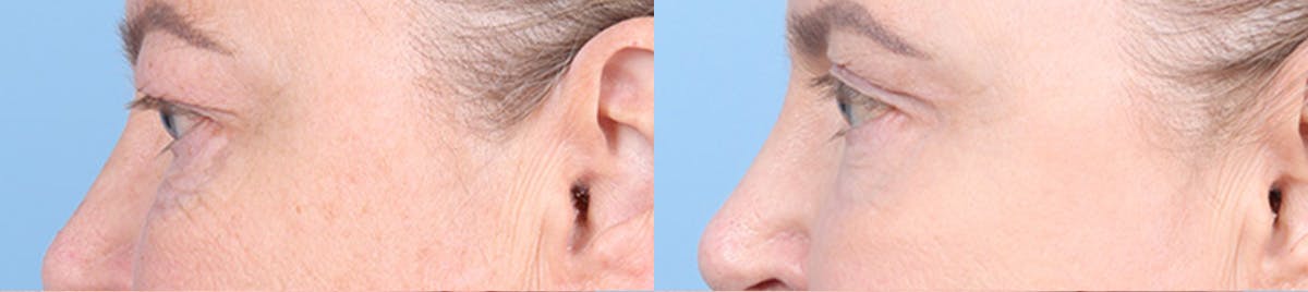 Eyelid Surgery Before & After Gallery - Patient 340727 - Image 5