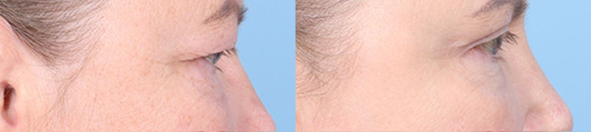 Eyelid Surgery Before & After Gallery - Patient 340727 - Image 3