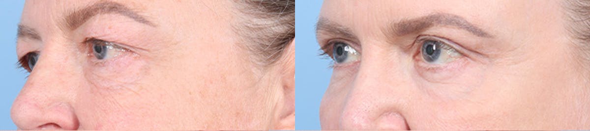 Eyelid Surgery Before & After Gallery - Patient 340727 - Image 4