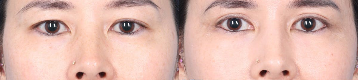 Eyelid Surgery Before & After Gallery - Patient 150179 - Image 1