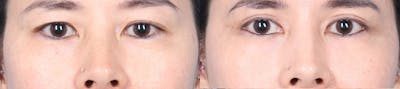 Eyelid Surgery Before & After Gallery - Patient 150179 - Image 1