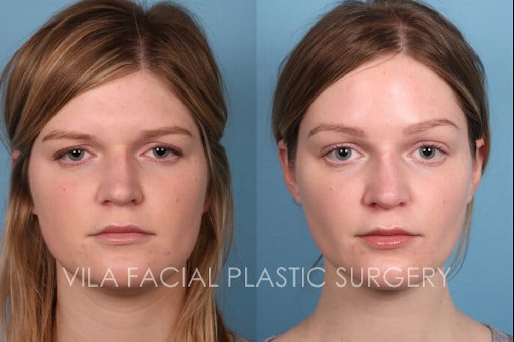 Brow Lift in Portland Before & After Photos