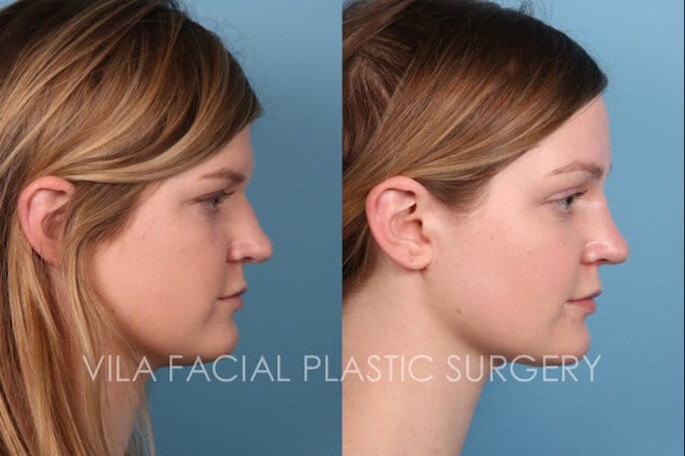 Browlift Before & After Gallery - Patient 221851 - Image 3
