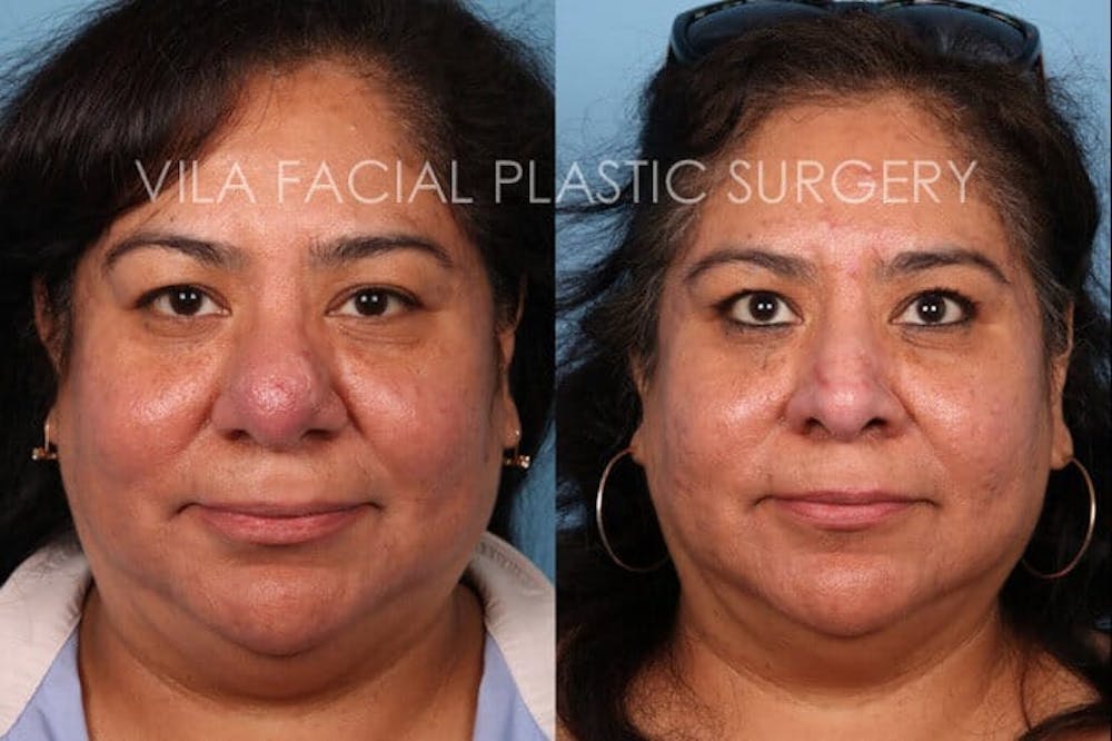 Rhinophyma Before & After Gallery - Patient 232247 - Image 1