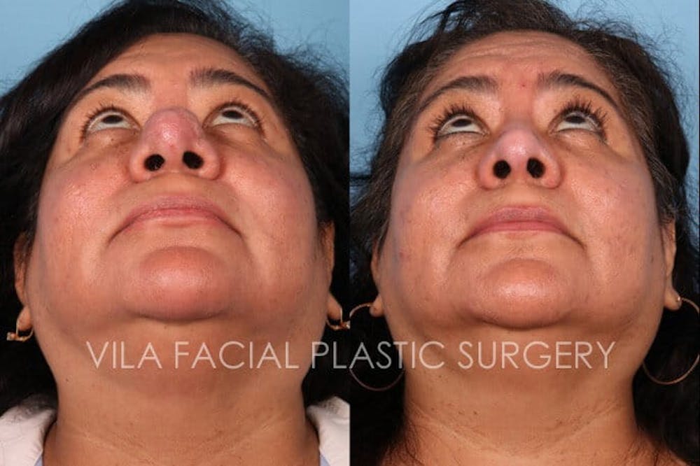 Rhinophyma Before & After Gallery - Patient 232247 - Image 3