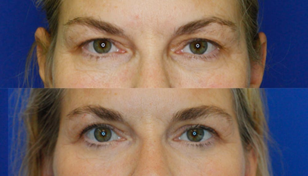 Upper Blepharoplasty Before & After Gallery - Patient 250238 - Image 1