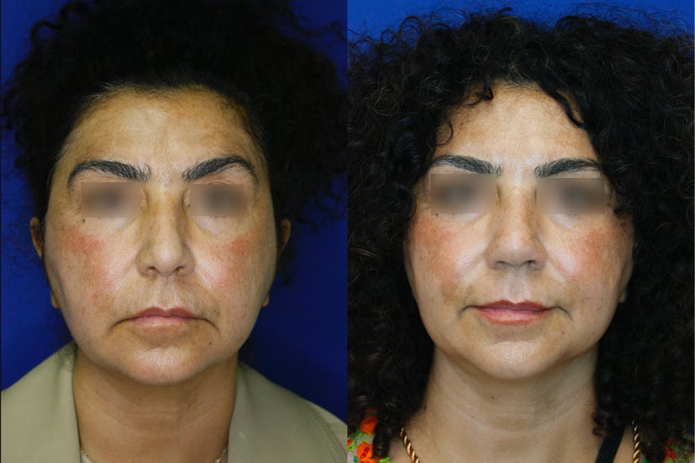 Rhinoplasty Before & After Gallery - Patient 255309 - Image 2