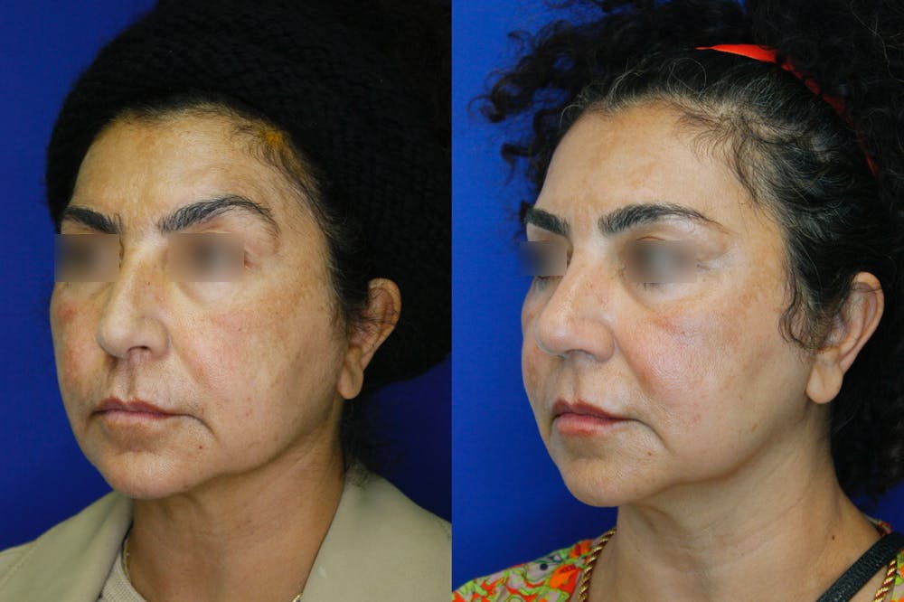 Rhinoplasty Before & After Gallery - Patient 255309 - Image 3