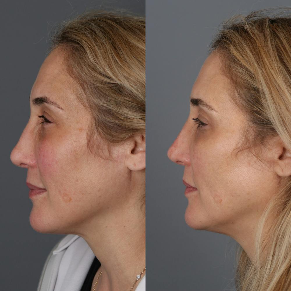 Liquid Rhinoplasty Before & After Gallery - Patient 329358 - Image 1