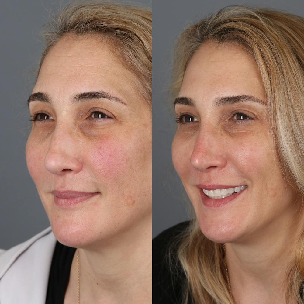 Liquid Rhinoplasty Before & After Gallery - Patient 329358 - Image 2