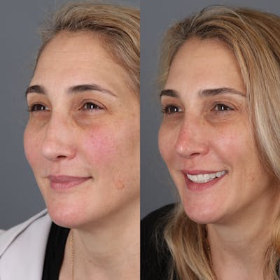 Liquid Rhinoplasty Before & After Gallery - Patient 329358 - Image 2