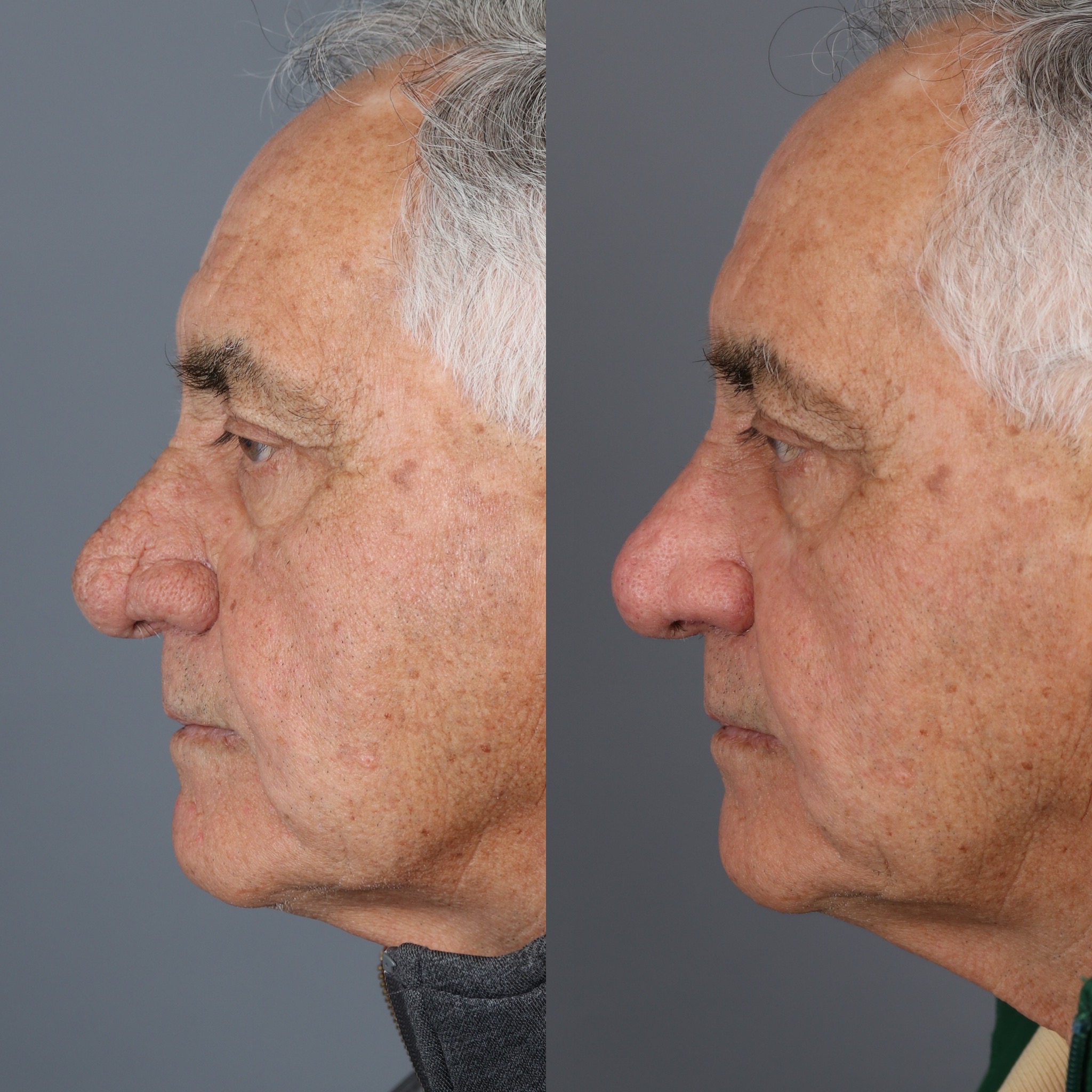 Rhinophyma Gallery | Vila Facial Plastic Surgery