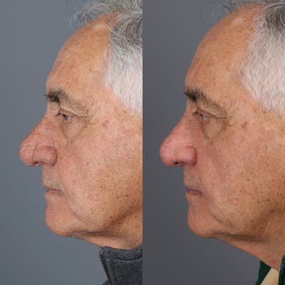 Rhinophyma Before & After Gallery - Patient 173241 - Image 1