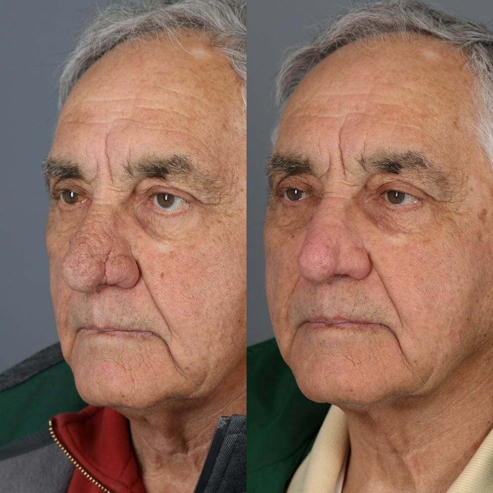 Rhinophyma Before & After Gallery - Patient 173241 - Image 2