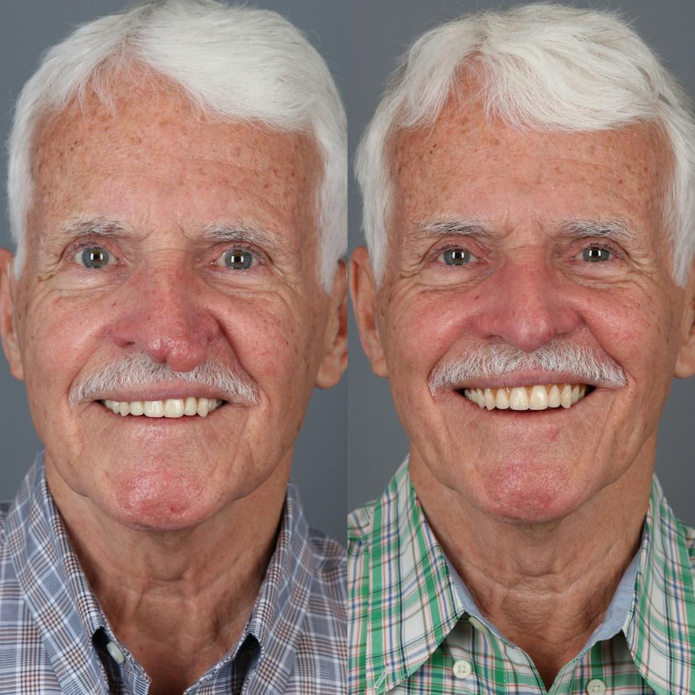 Rhinophyma Before & After Gallery - Patient 279515 - Image 3