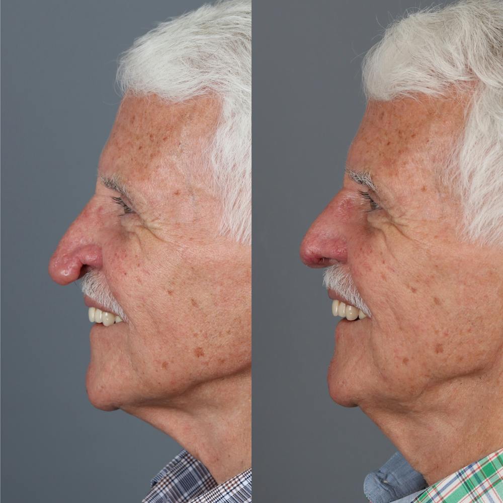 Rhinophyma Before & After Gallery - Patient 279515 - Image 1