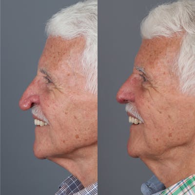 Rhinophyma Before & After Gallery - Patient 279515 - Image 1