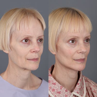 Face & Neck Lift Before & After Gallery - Patient 402760 - Image 1