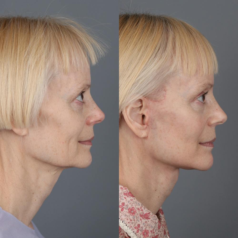 Face & Neck Lift Before & After Gallery - Patient 402760 - Image 2