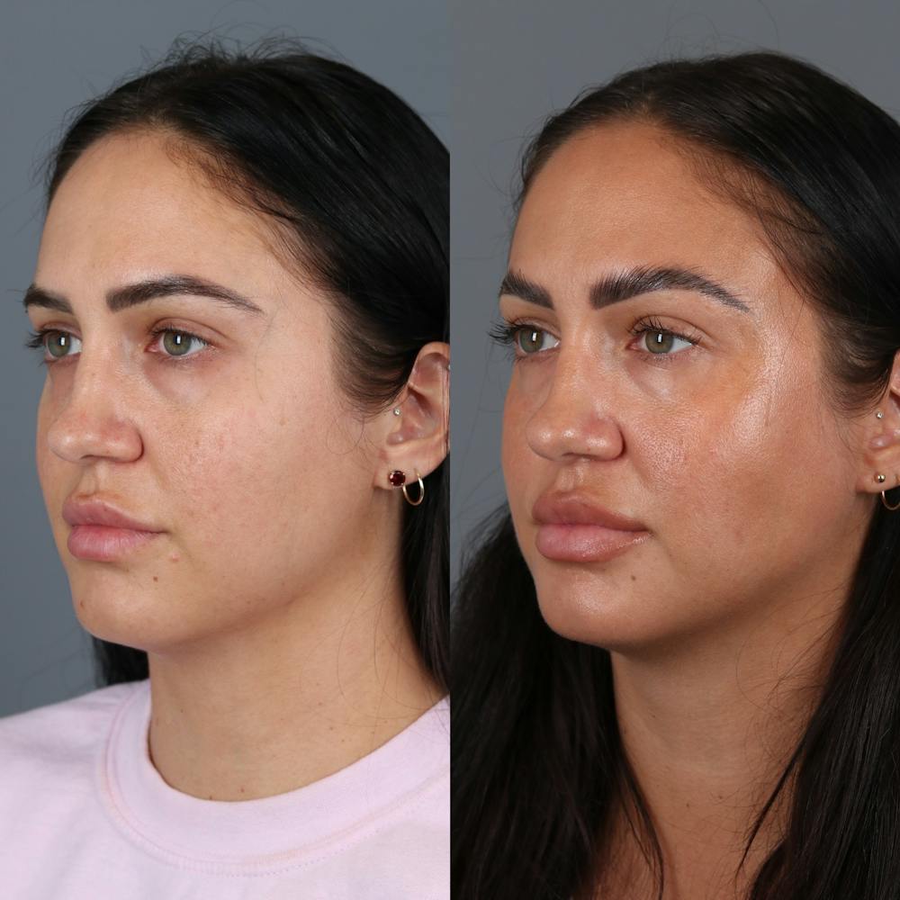 Buccal Fat Removal Before & After Gallery - Patient 427866 - Image 2