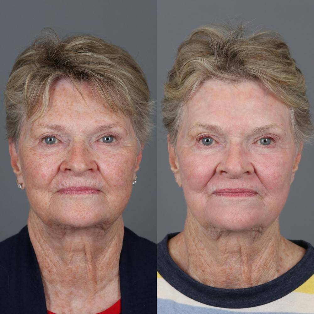 Laser Skin Resurfacing Before & After Gallery - Patient 232859 - Image 1