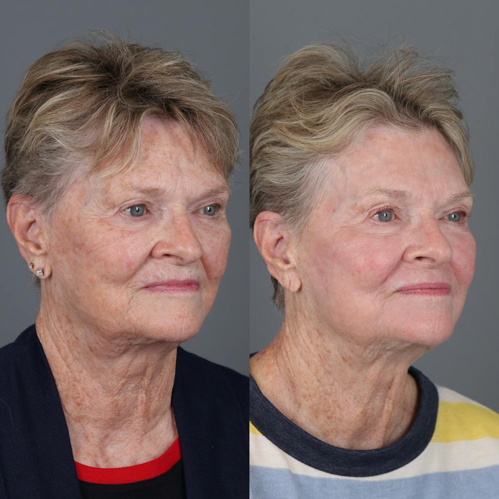 Laser Skin Resurfacing Before & After Gallery - Patient 232859 - Image 2