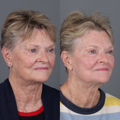 Laser Skin Resurfacing Before & After Gallery - Patient 232859 - Image 2