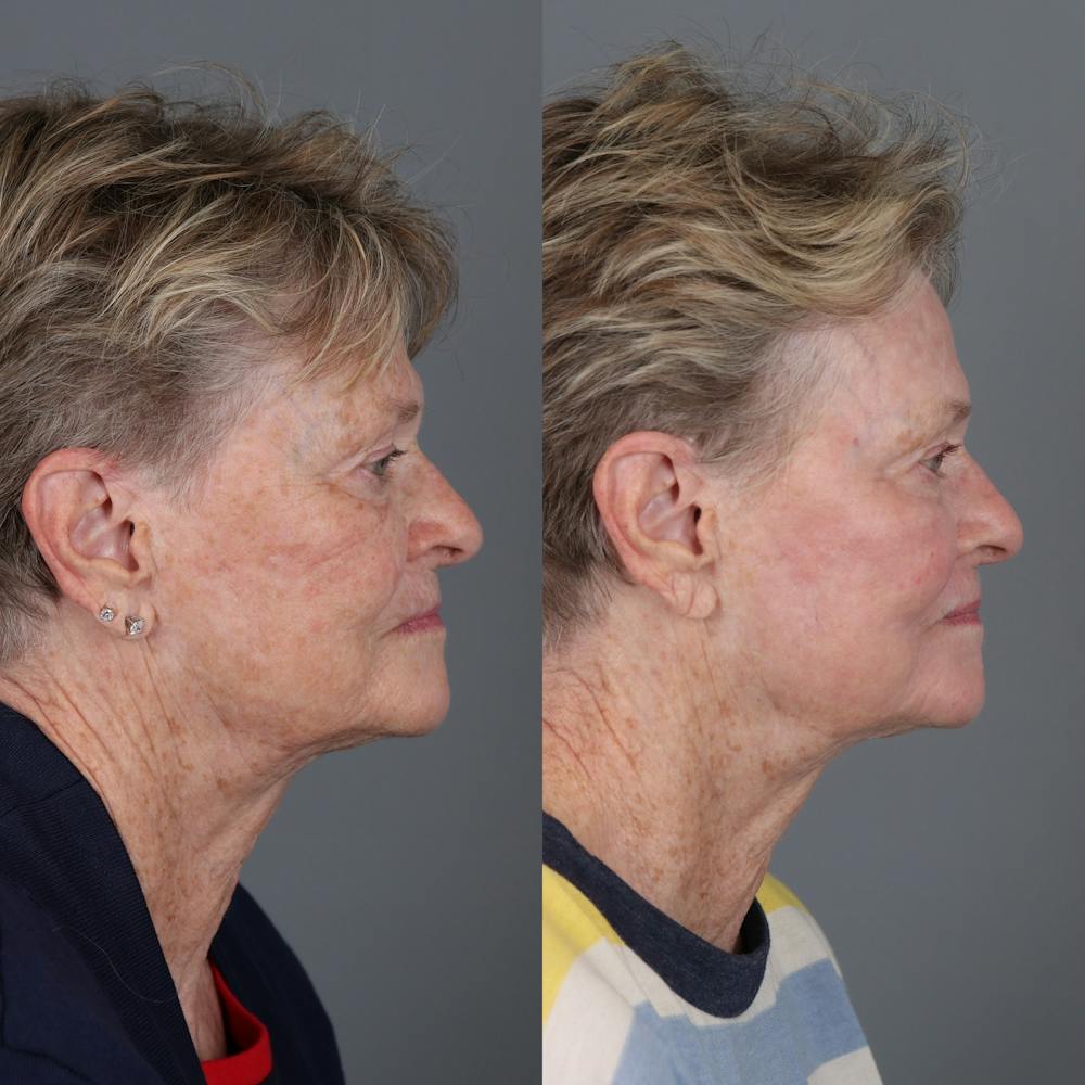 Laser Skin Resurfacing Before & After Gallery - Patient 232859 - Image 3