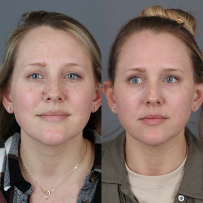 Laser Skin Resurfacing Before & After Gallery - Patient 971916 - Image 1