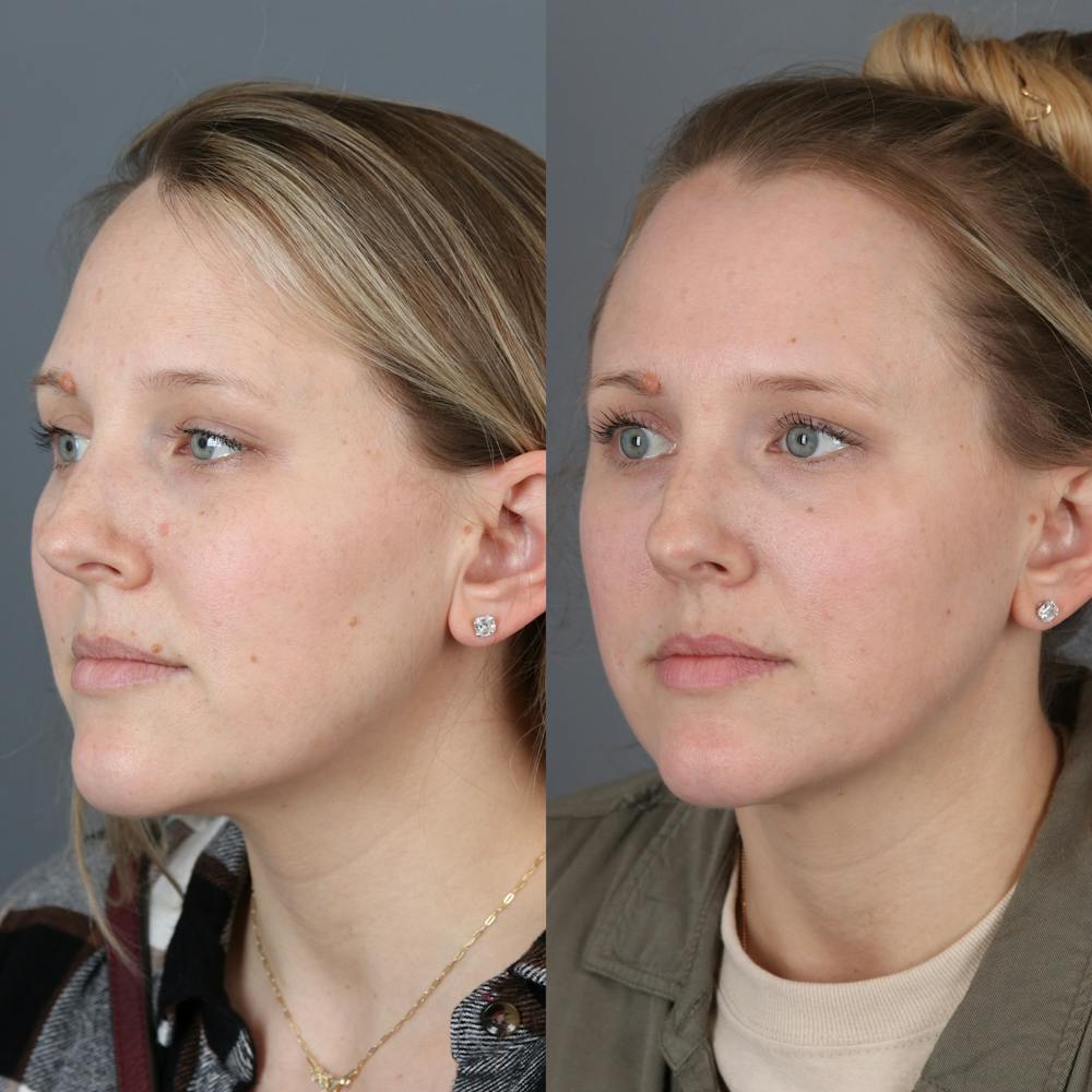 Laser Skin Resurfacing Before & After Gallery - Patient 971916 - Image 2