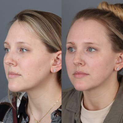 Laser Skin Resurfacing Before & After Gallery - Patient 971916 - Image 2