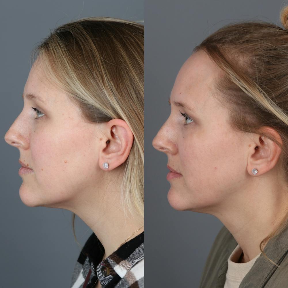 Laser Skin Resurfacing Before & After Gallery - Patient 971916 - Image 3