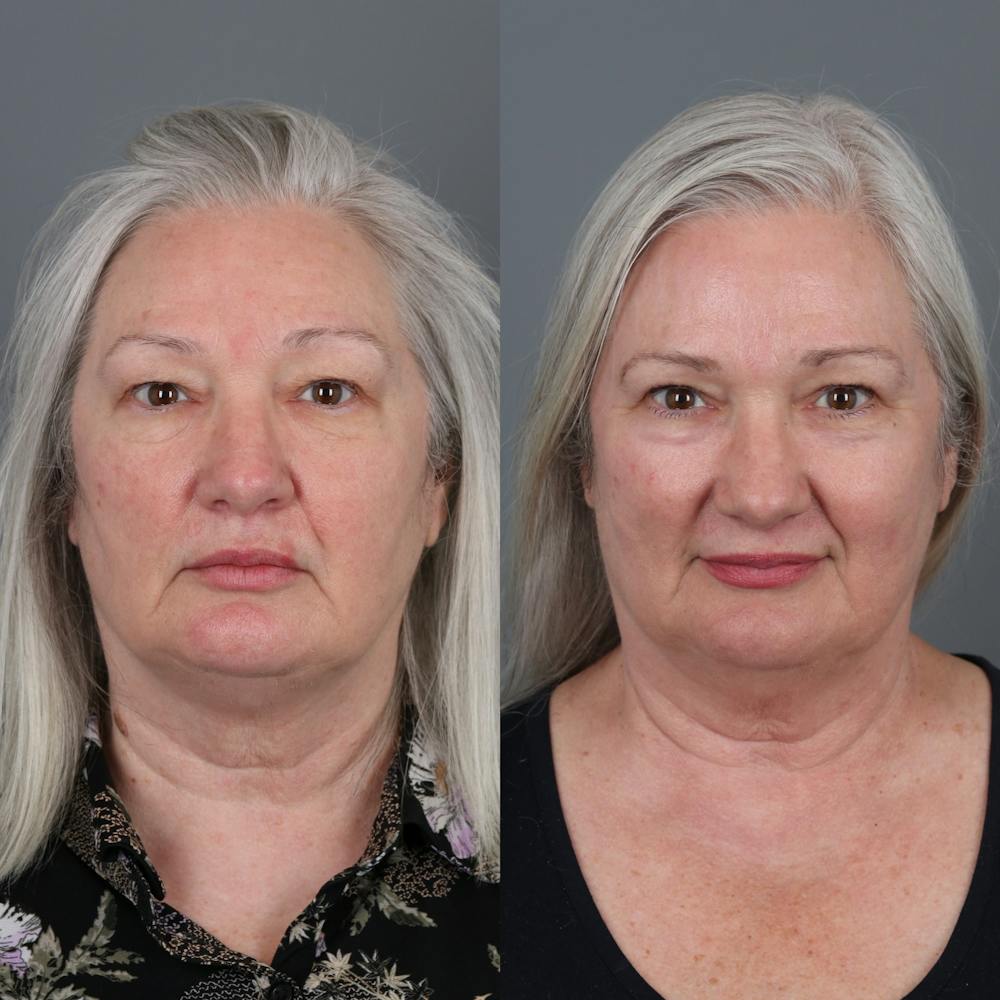 Laser Skin Resurfacing Before & After Gallery - Patient 149529 - Image 1