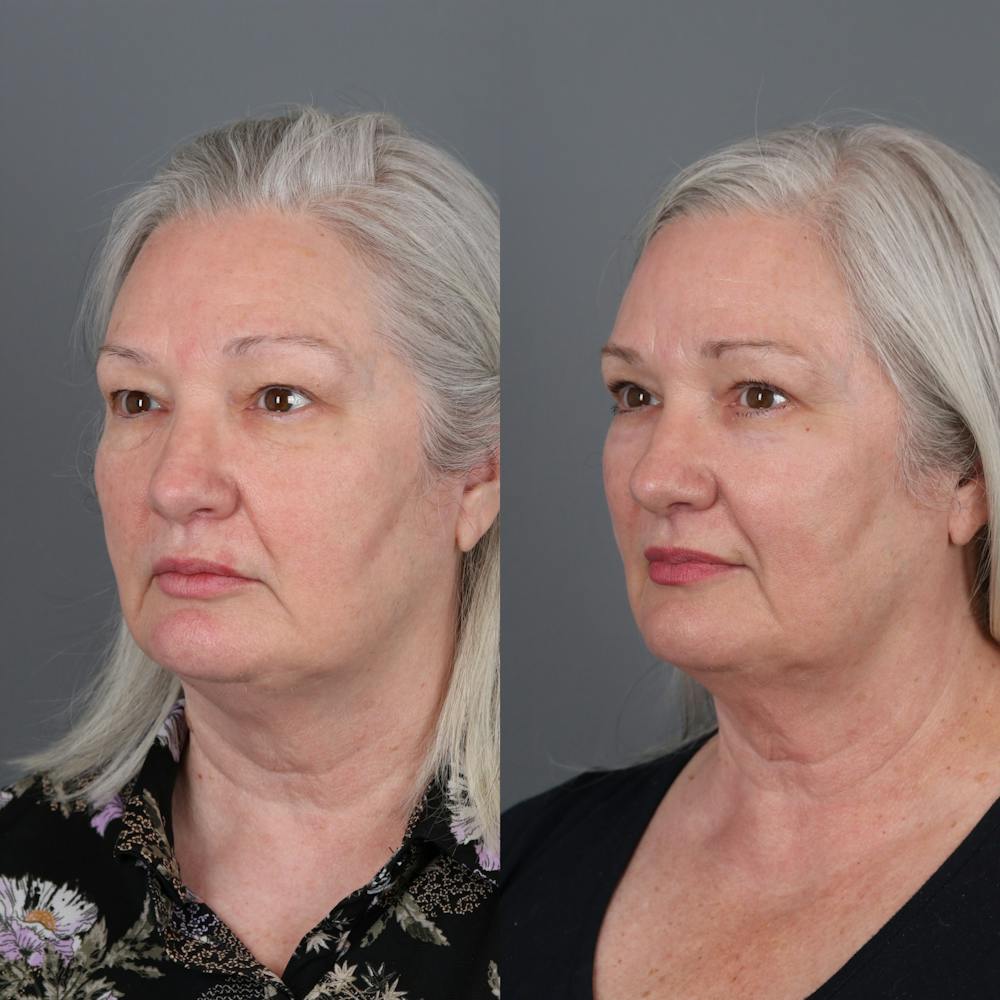 Laser Skin Resurfacing Before & After Gallery - Patient 149529 - Image 2