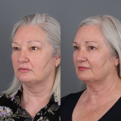 Laser Skin Resurfacing Before & After Gallery - Patient 149529 - Image 2