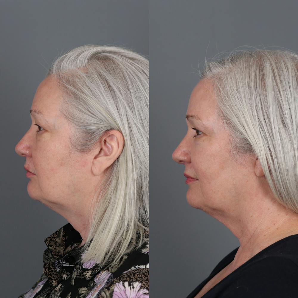 Laser Skin Resurfacing Before & After Gallery - Patient 149529 - Image 3