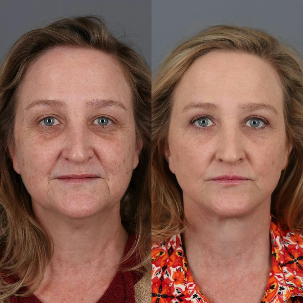 Face & Neck Lift Before & After Gallery - Patient 312264 - Image 4